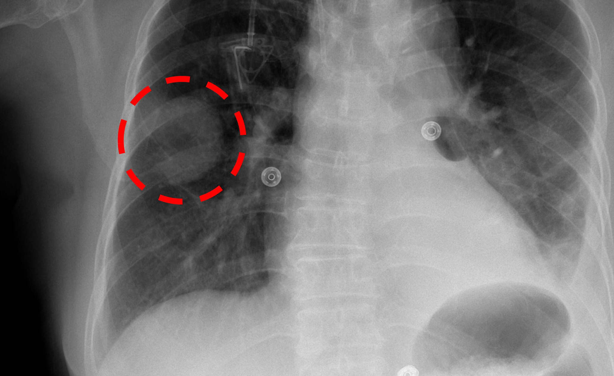 Chest x-ray identifies a lung mass.