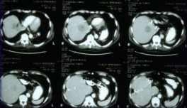 CT scan of the liver before ablation shows large solitary lesion from colorectal carcinoma