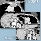 X-Ray images of breast cancer