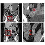 CT scans