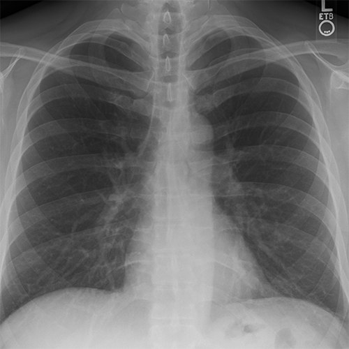 xray scan of ribcage area