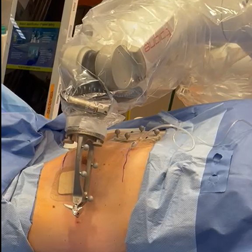 photo of a robotic arm doing surgery