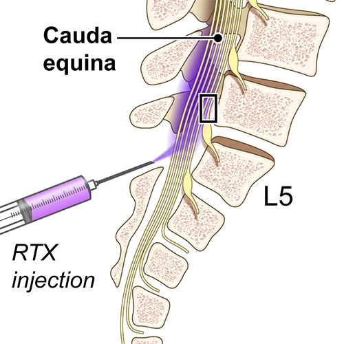 illustration of injection into spine