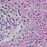 Skin findings in a patient with VEXAS syndrome viewed under a microscope