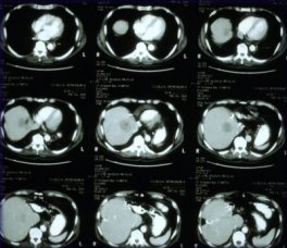 ct scan of the liver