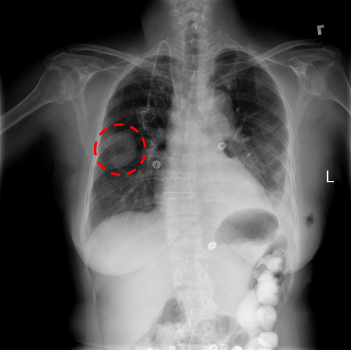 A chest x-ray identifies a lung mass.