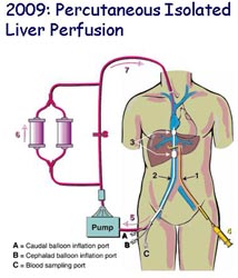 Today percutaneous (with small incisions) devices are used to deliver high-dose regional chemotherapy