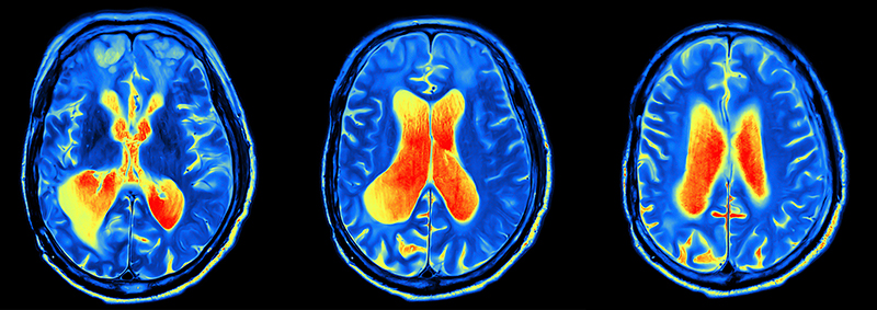 MRI brain scans