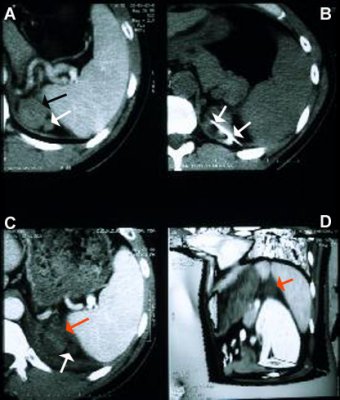 Adrenal tumor