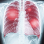 Chest x-ray