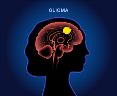 Medical illustration highlighting a glioma in the glial cells of the brain with text that reads GLIOMA