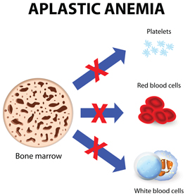 Aplastic Anemia diagram