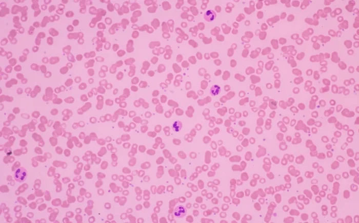 A microscopic view of red blood cells on a pink background with a few purple-stained white blood cells visible.