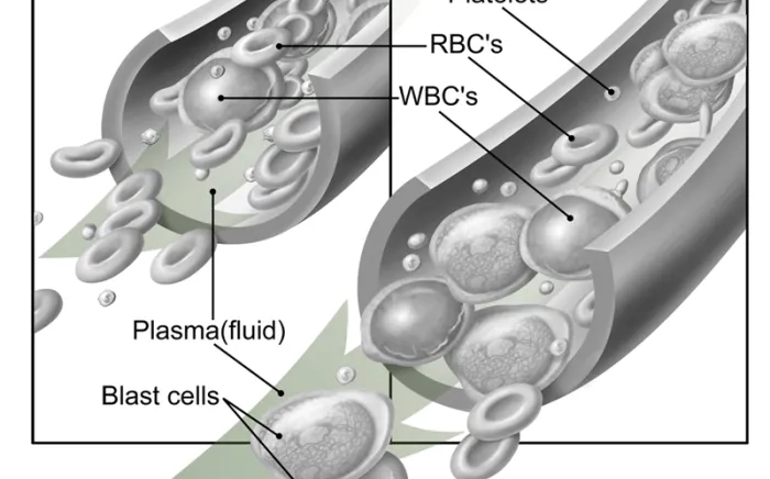 A diagram of a blood vessel demonstrating leukemia in the blood.