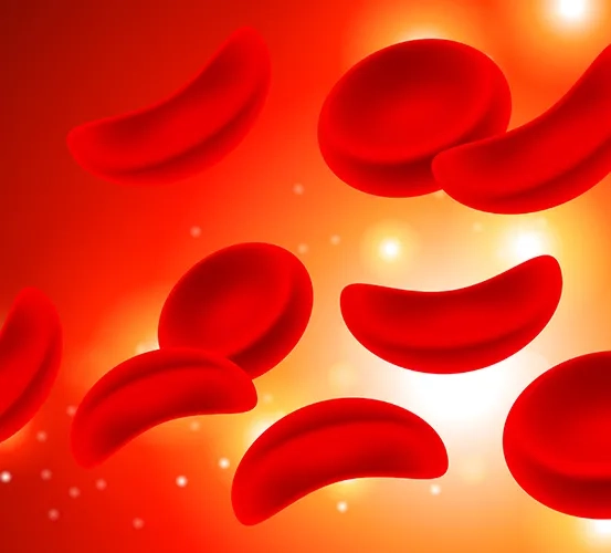 Medical illustration displaying disc-shaped normal red blood cells and rigid, C-shaped sickle cells