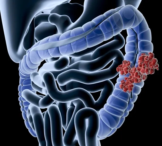 An Open-Label, Proof of Concept Study of Vorinostat for the Treatment of Moderate-to-Severe Crohn s Disease and Maintenance Therapy with Ustekinumab