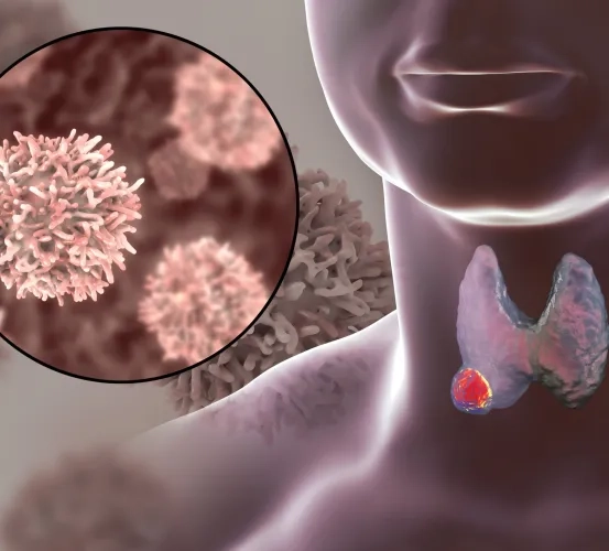 The Use of 124-I-PET/CT Whole Body and Lesional Dosimetry in Differentiated Thyroid Cancer