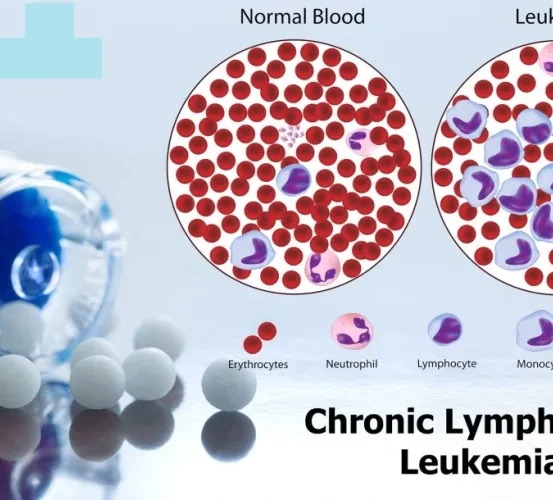 Early Clonal Dynamics During Venetoclax Treatment for Chronic Lymphocytic Leukemia (CLL)