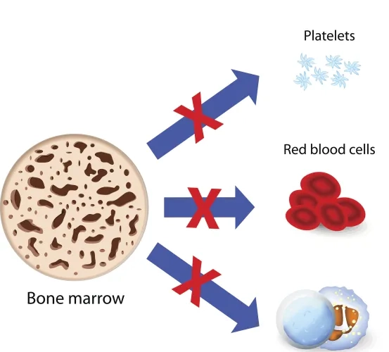 Research Study for Severe Aplastic Anemia (SAA)