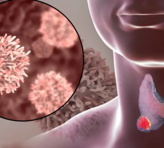 Studies on Tumors of the Thyroid